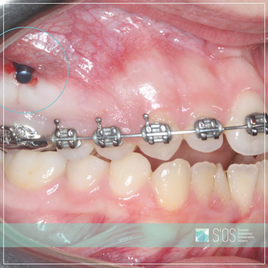 Ar žinote kas yra ortodontinis mikroimplantas?