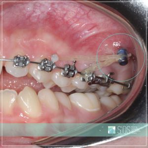 Ar žinote kas yra ortodontinis mikroimplantas?