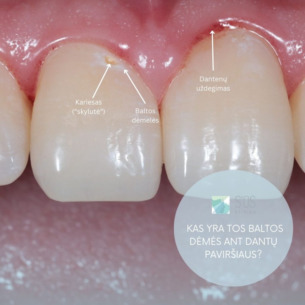 Kas yra tos baltos dėmės ant dantų paviršiaus?