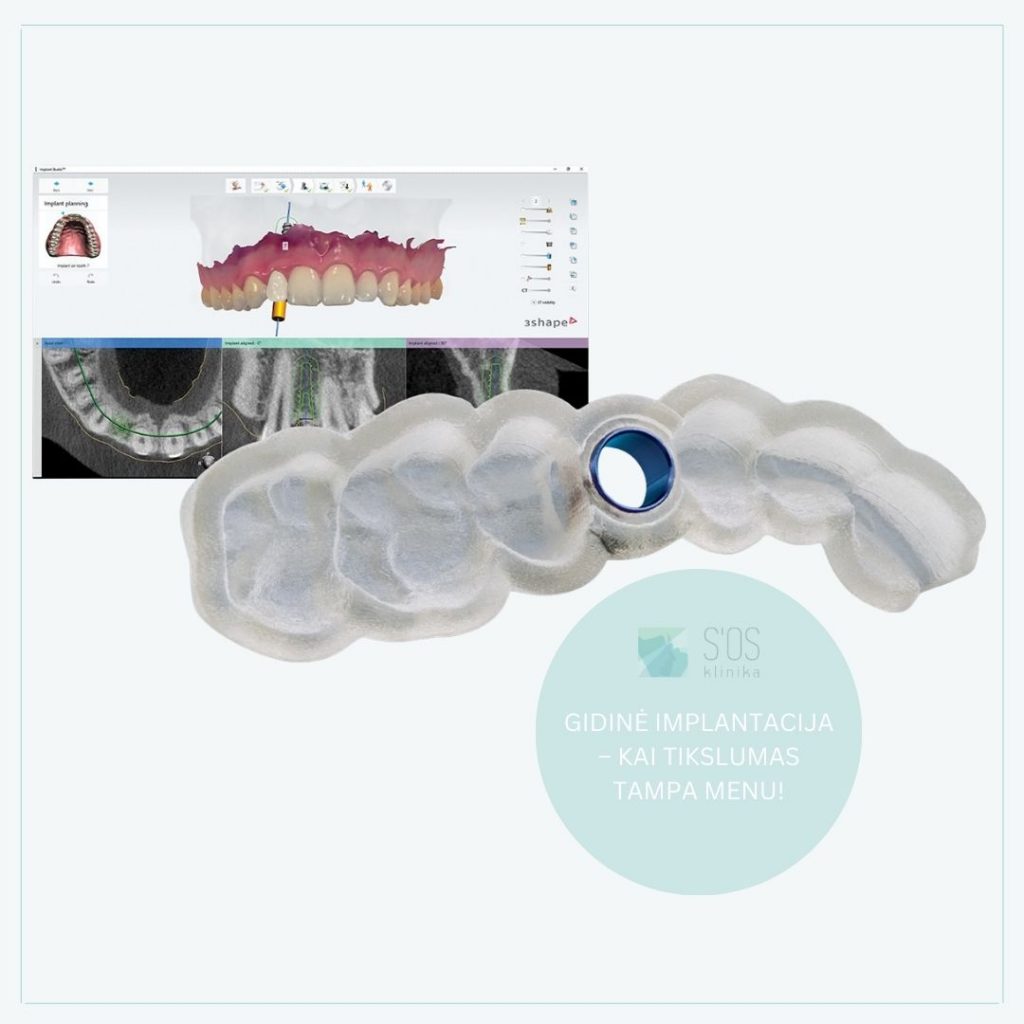 Gidinė implantacija