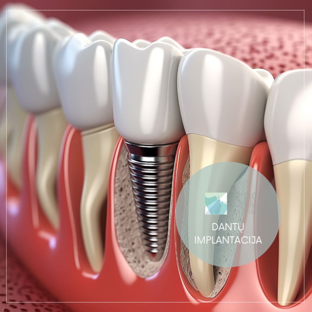 S'OS dantų implantacija