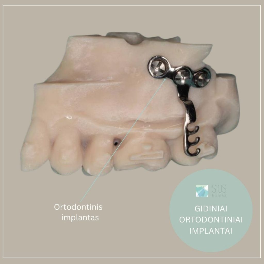 Ortodontinis implantas
