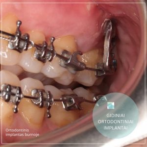 Ortodontinis implantas